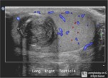 epidermoid cyst testicle